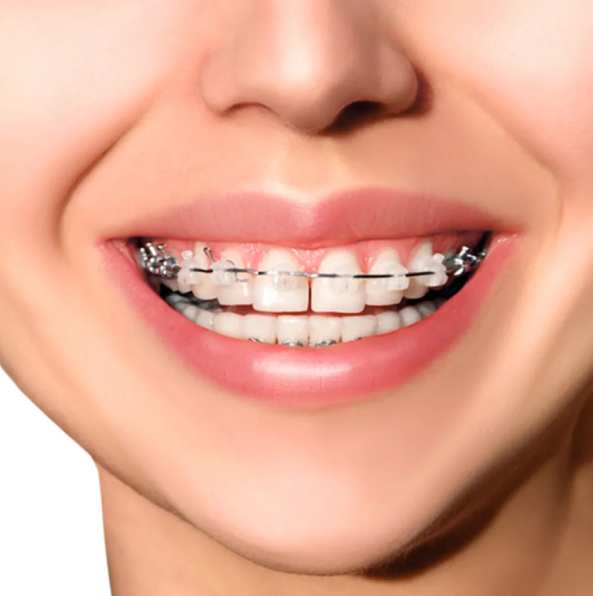 Metro Orthodontics Heat-Activated (HANT) Rectangular NiTi Archwires - Upper