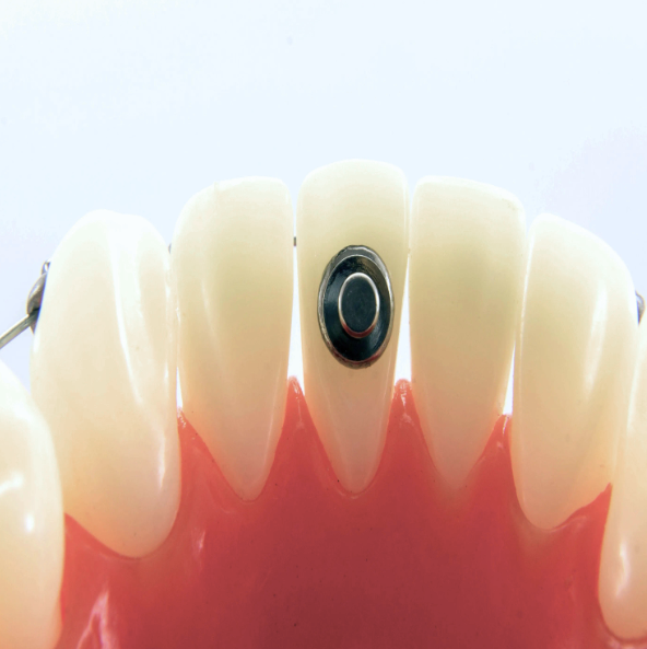 Metro Orthodontics Weldable Buttons Band Attachment