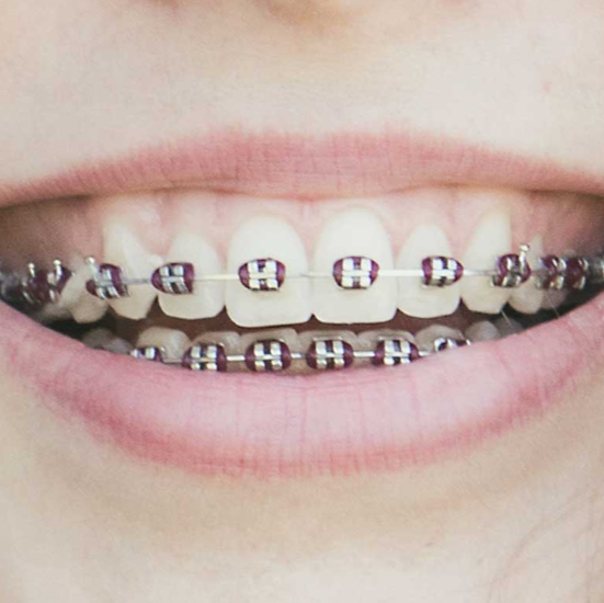 Metro Orthodontics Tapered Round Lingual NiTi Archwires - 0.016 Upper