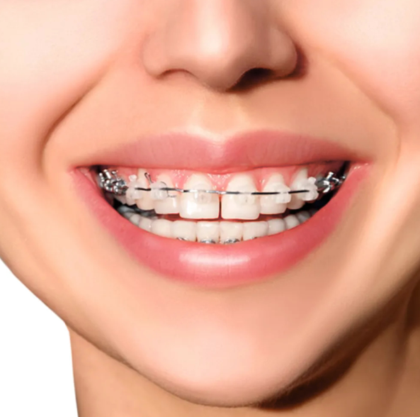 Metro Orthodontics Round Tooth Coloured Super Elastic Stainless Steel Archwires - Upper