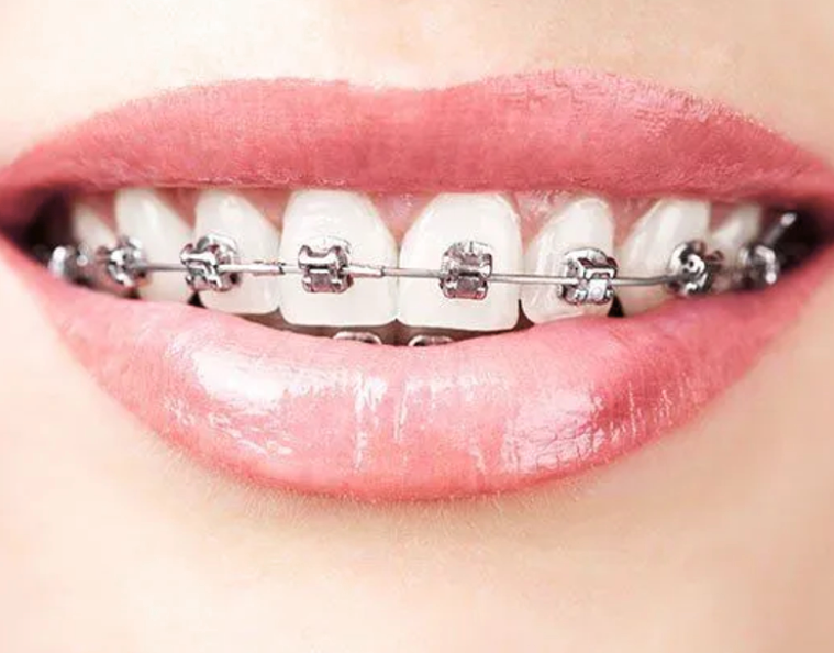 Metro Orthodontics Super Series Pack of 20 Metal Conventional Brackets - 022 MBT