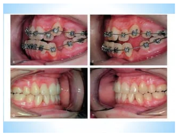 Metro Orthodontics Box of 240 U3/L2 Orthodontic Bands