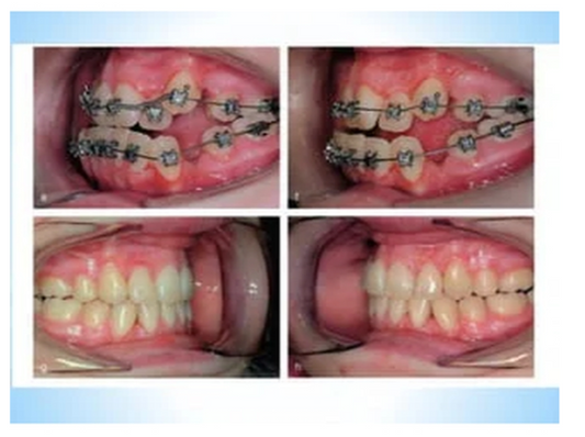 Metro Orthodontics Box of 240 U3/L2 Orthodontic Bands