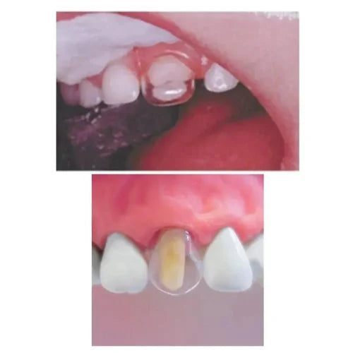 Tor Vm Transparent Crowns 40 Pcs Premolar No. 1.911P