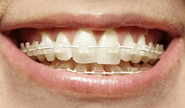 U Ortho SS Tooth Color Wire - Rectangular