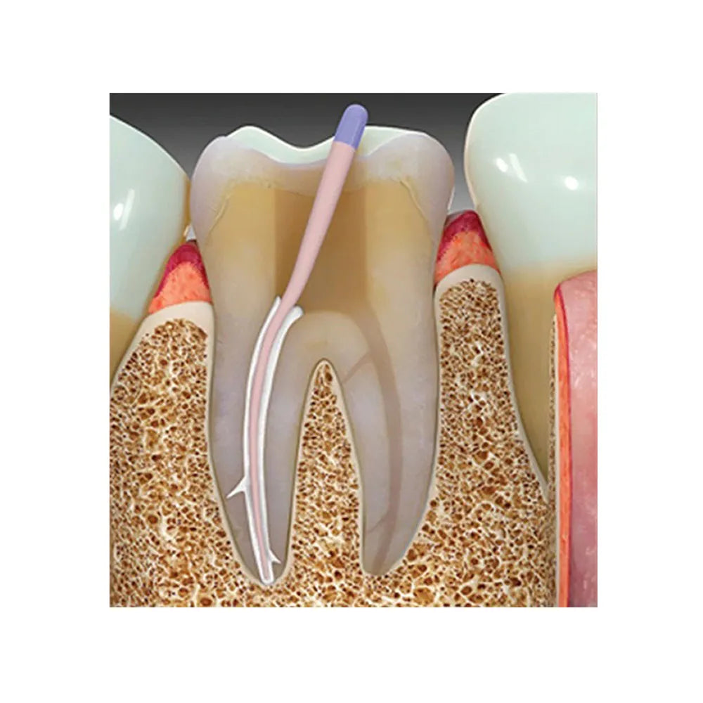 Woodpecker KP Root Injectable Root Canal Sealer