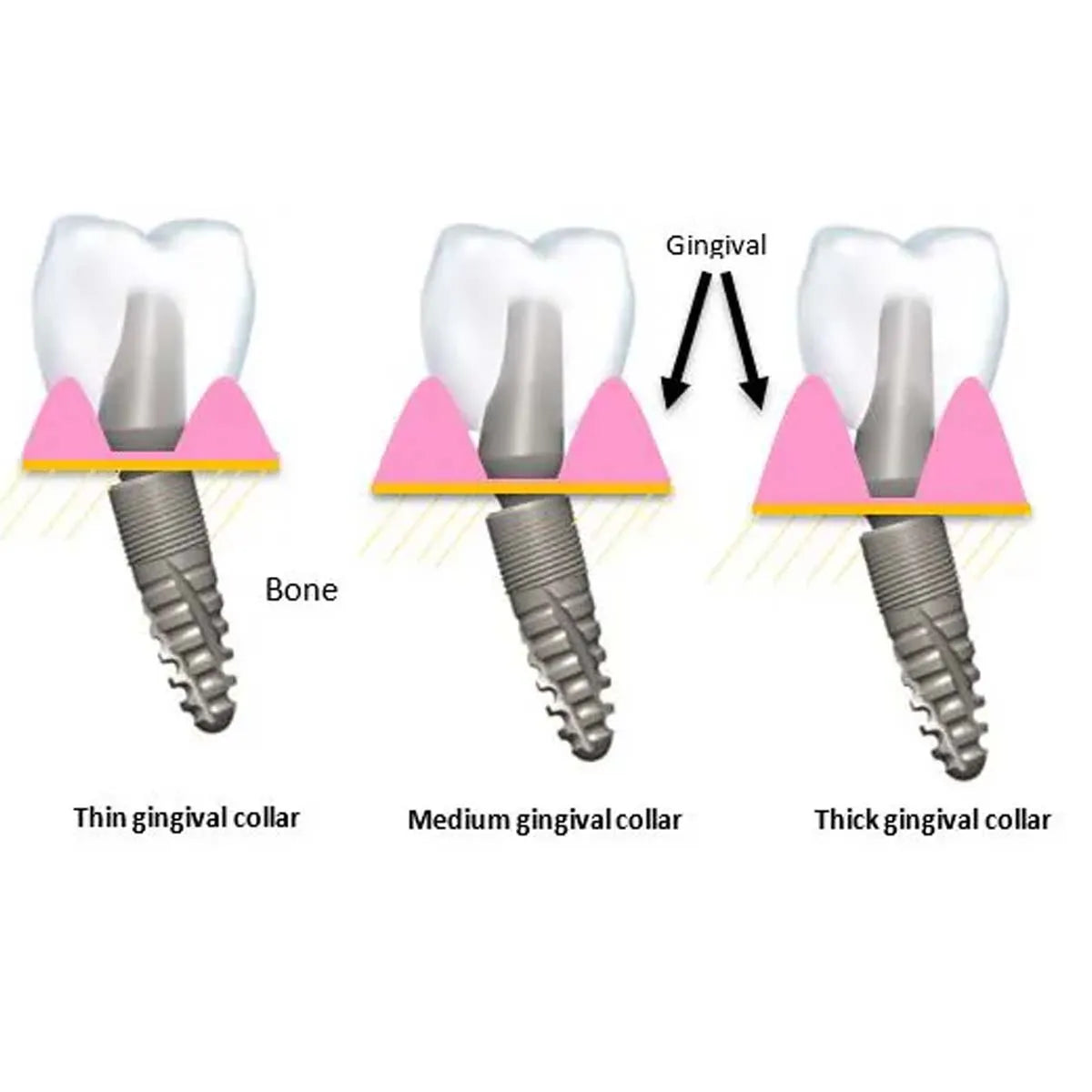 Xcem Dental Implant Angled Abutment Type A Mini 4.5mm - Hex