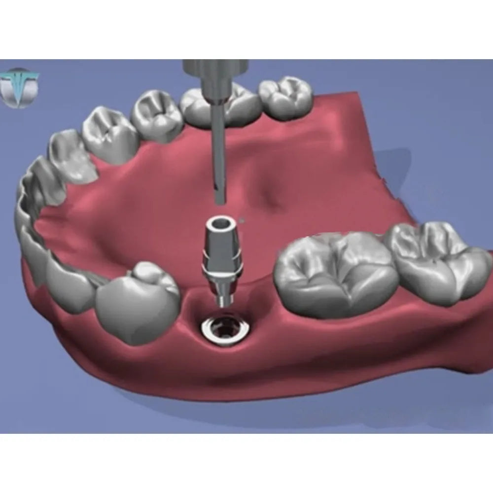 Xcem Dental Implant Mini Submerged Solid Abutment 4mm