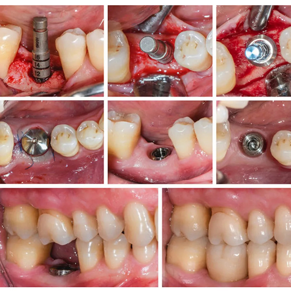 Xcem Dental Implant Submerged Healing Abutment 6.5mm