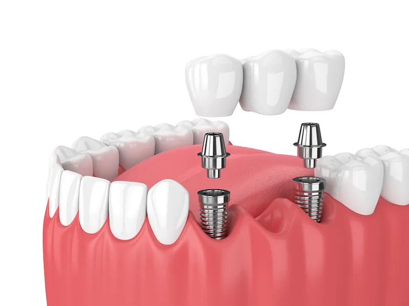 Xcem Dental Implant Transfer Abutment 6.5mm - Hex