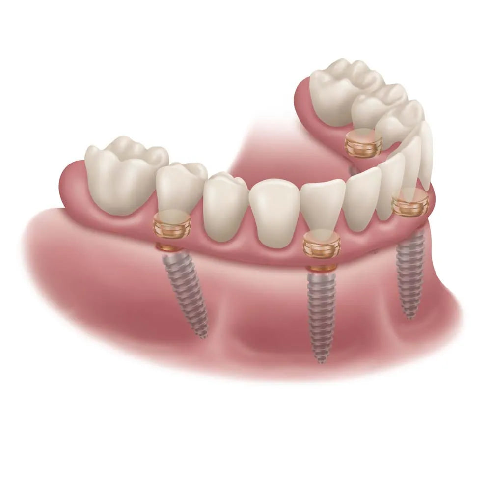 Xcem Denture Locator Abutment - Hex