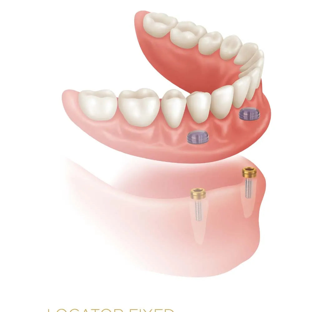 Xcem Denture Locator Abutment Mini - Hex