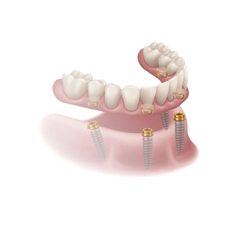 Xcem Denture Locator Abutment Mini - Hex