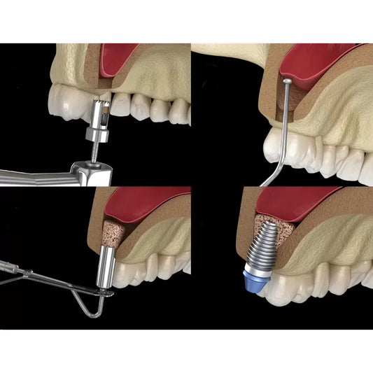 Xcem Osspore Bone Grafts For Sinus And Implantitis Repair