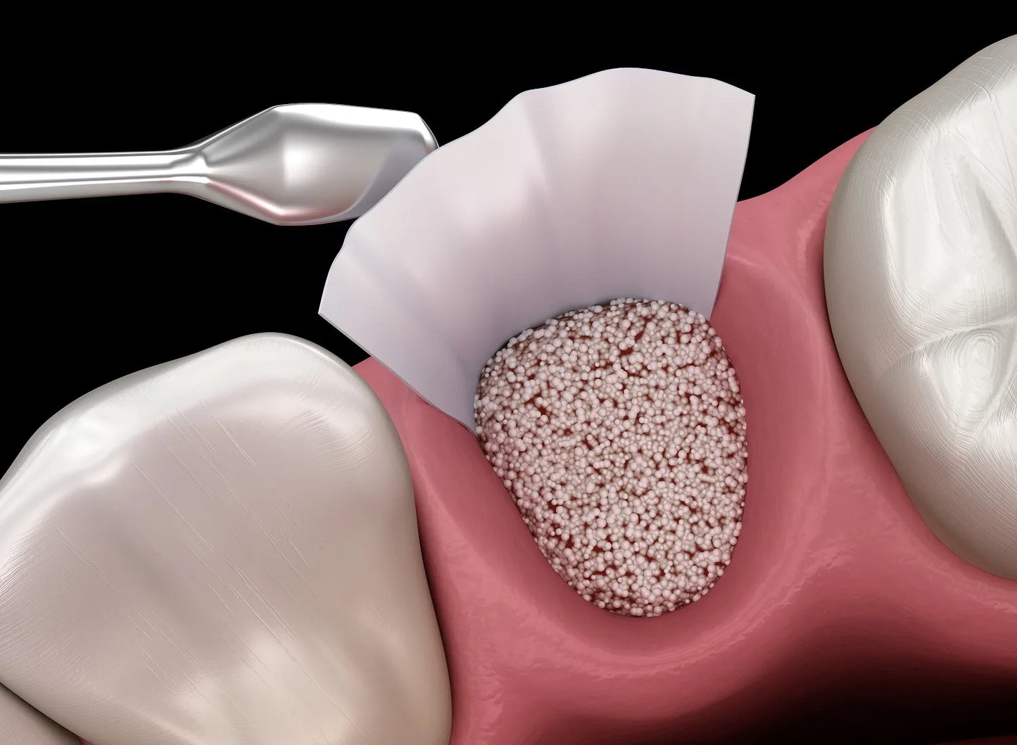 Xcem Osspore Synthetic Bone Grafts HA / B-TCP Mix In Syringe