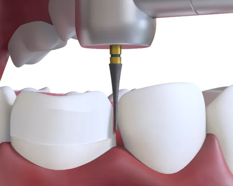 Denext FG Kit Crown Preparation Kit - Prep