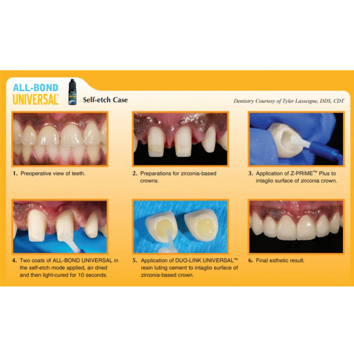 Bisco All Bond Universal LC Adhesive 4ml