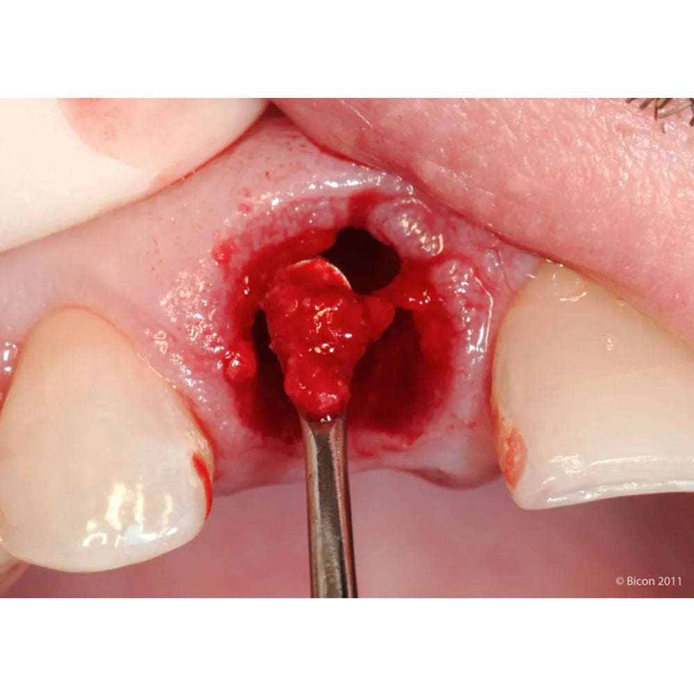 GDC Surgical Curette Lucas #4 (Cl86)