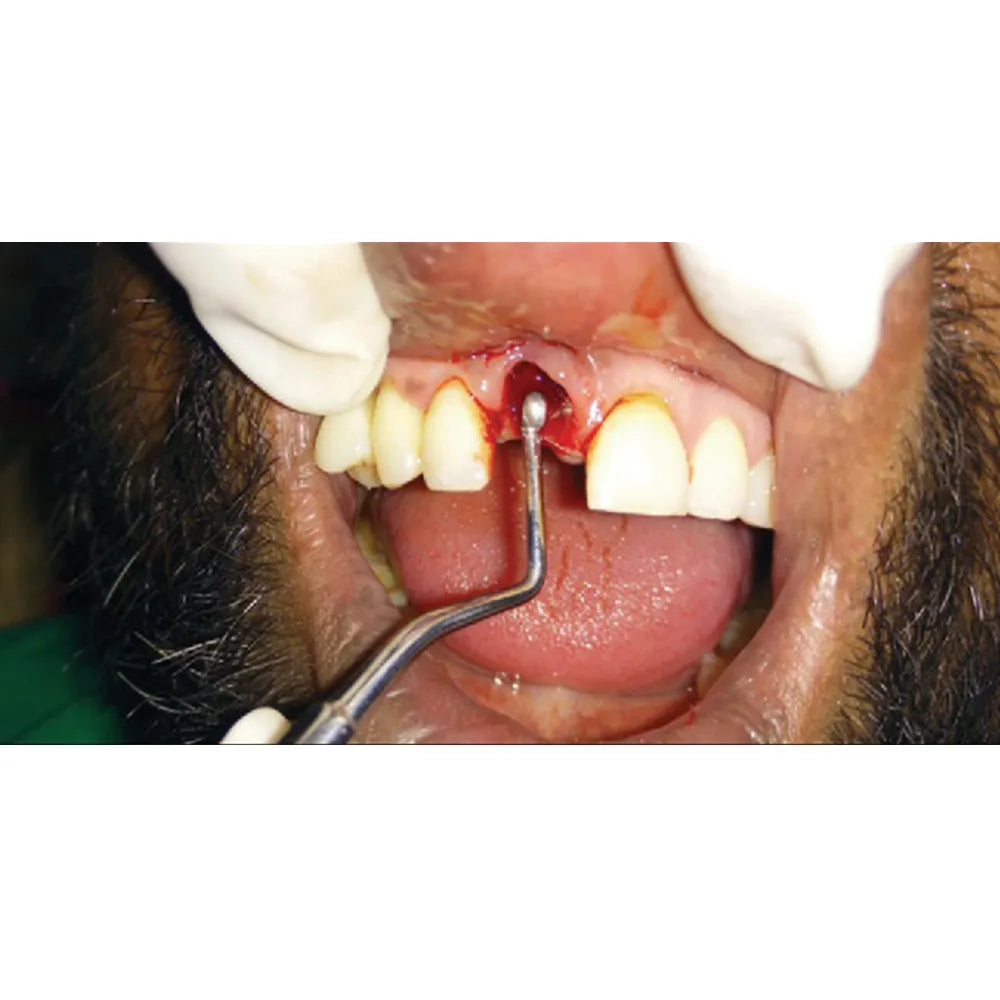 GDC Surgical Curette Lucas #4 (Cl86)