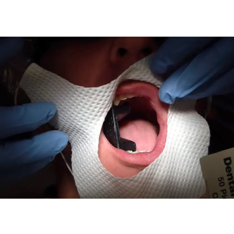 Dentogenie Mouth Prop - Set of 3