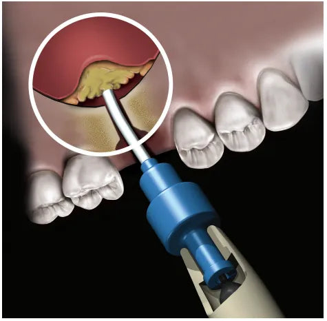 Novabone Dental Putty Cartridge Form
