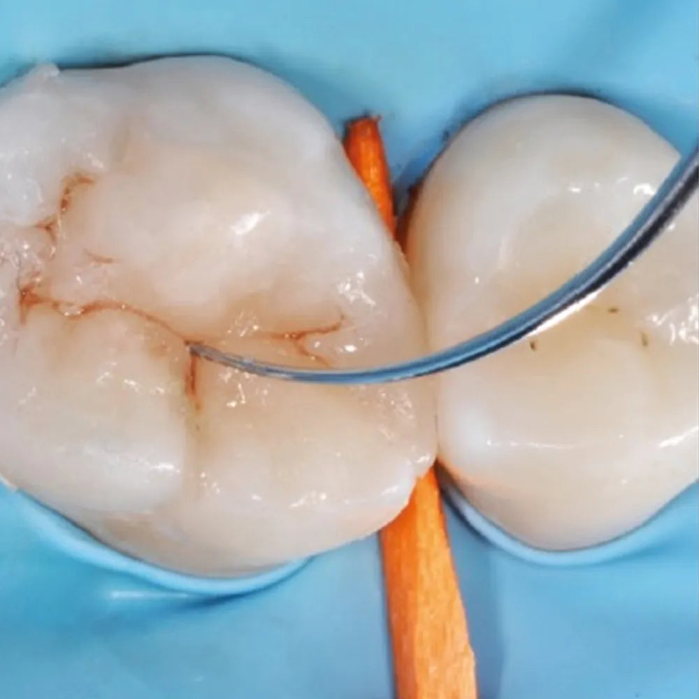 GDC Restore Instrument - Fissura