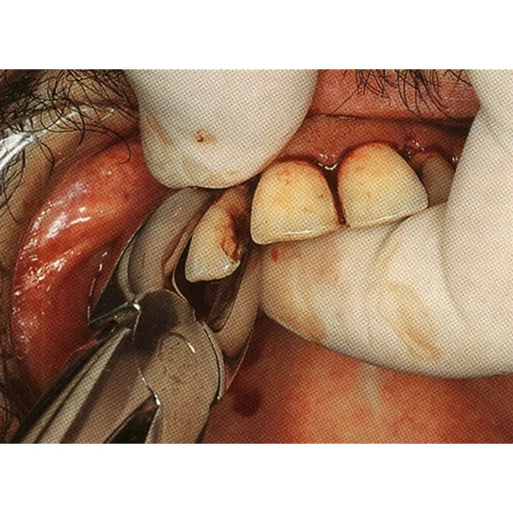 GDC Extraction Forceps Upper Anteriors - 1 Premium (FX1P)