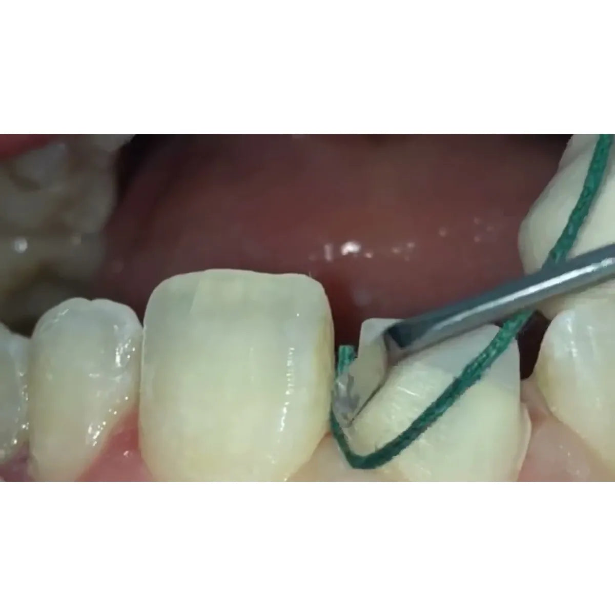 GDC Gingival Cord Packer Non-Serrated #4 (Gcpr7n)