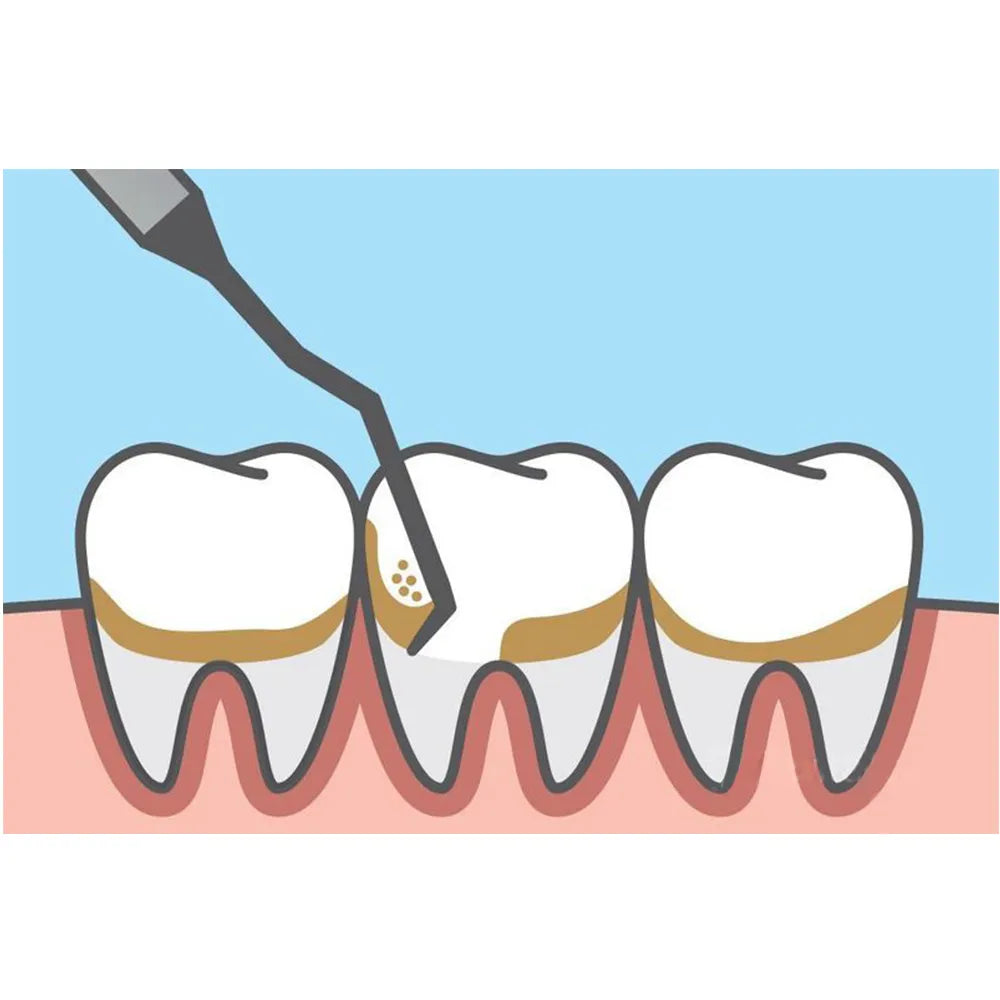 GDC Gracey Curettes #6 (Sg7/8)