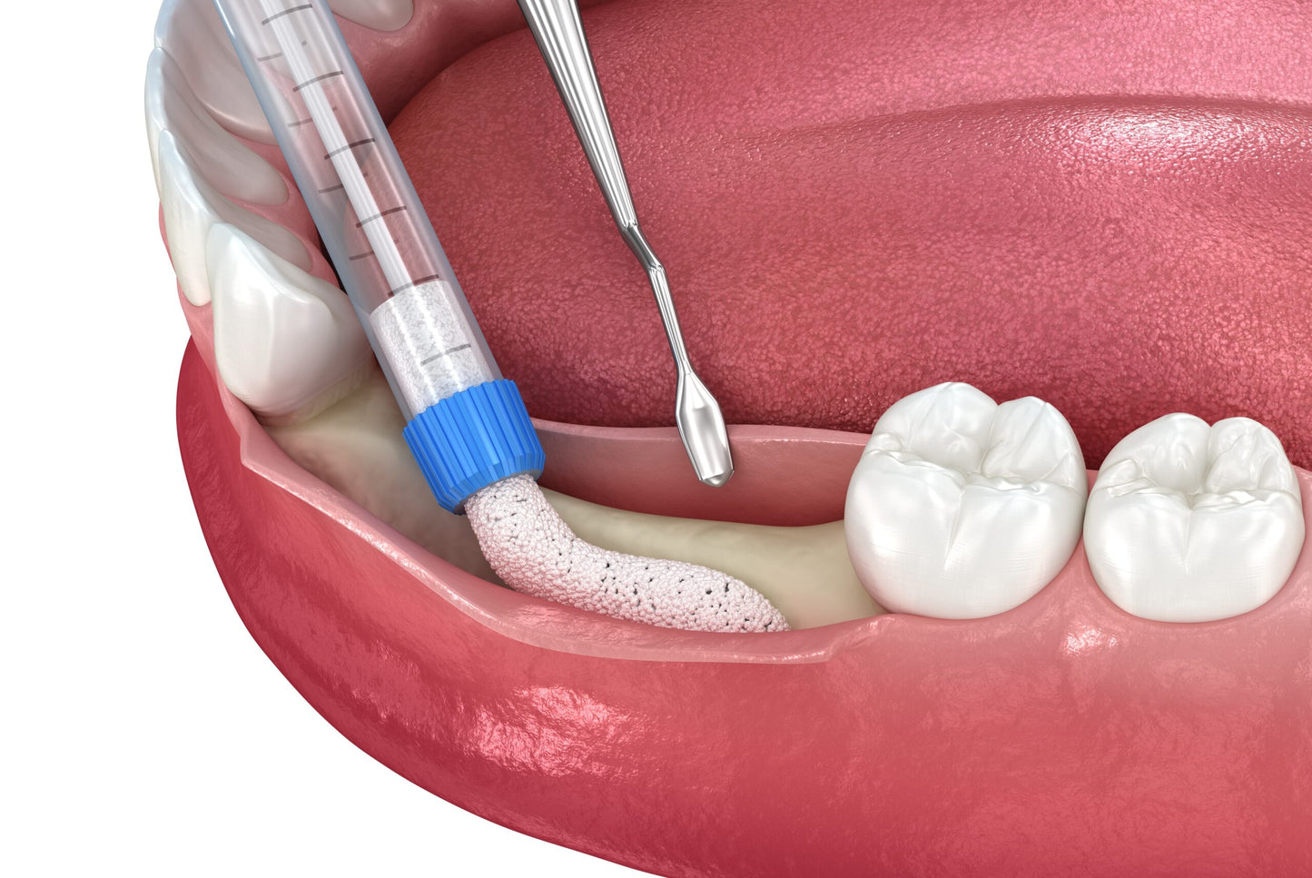 Xcem OSSPORE Bioglass Bioactive Synthetic Bone Graft