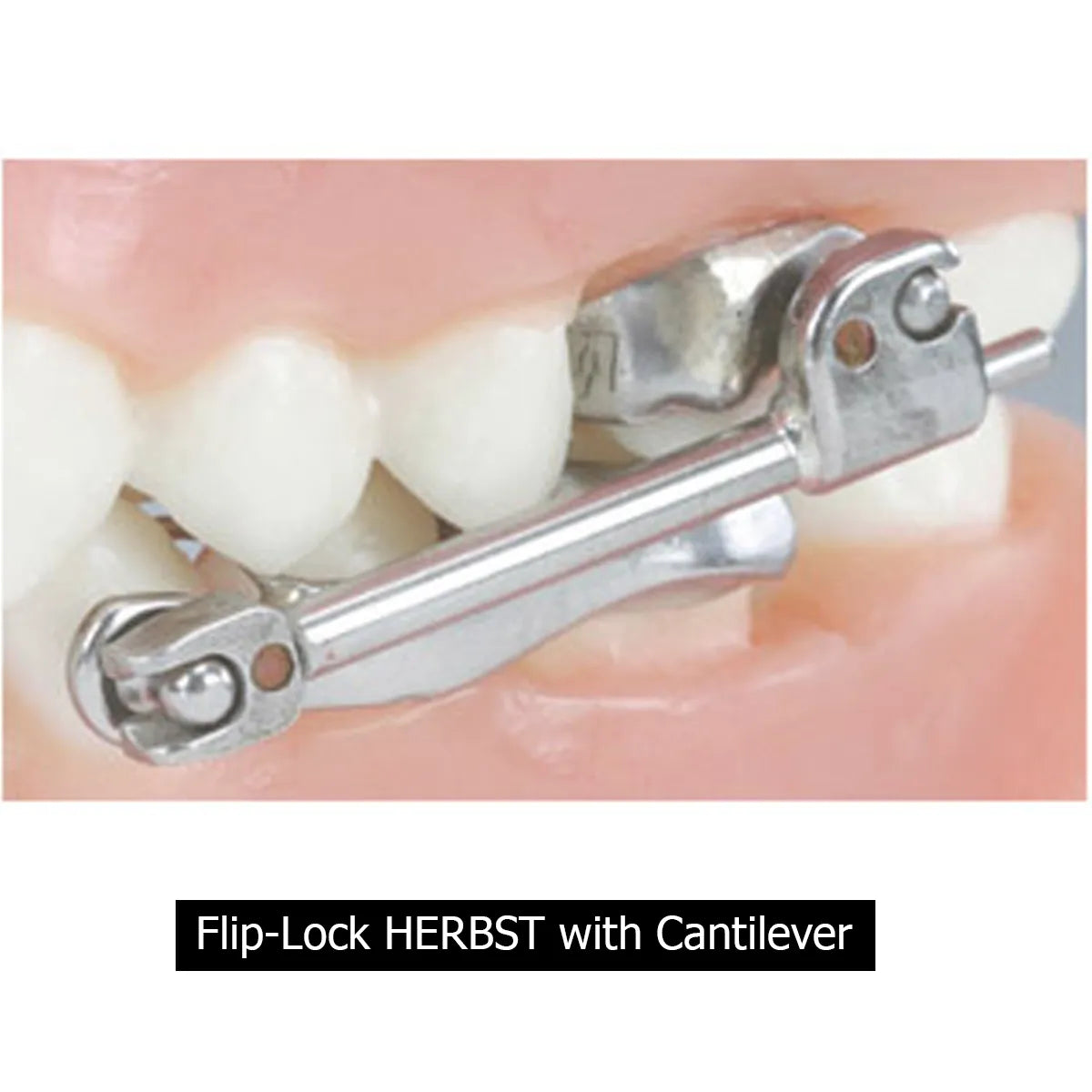 TP Ortho Flip-Lock Herbst Appliance - 610-400