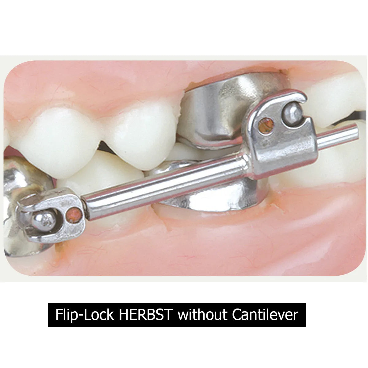 TP Ortho Flip-Lock Herbst Appliance - 610-400