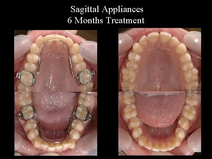 Ortho Organizers Transforce Sagittal Appliance