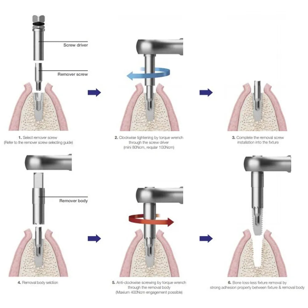 MCTBIO Fixture Remover Kit (FRK-01)
