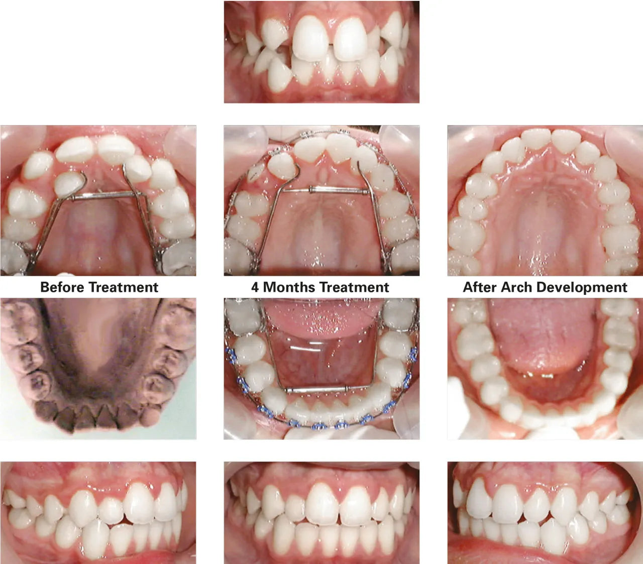 Ortho Organizers Transforce Transverse Appliance