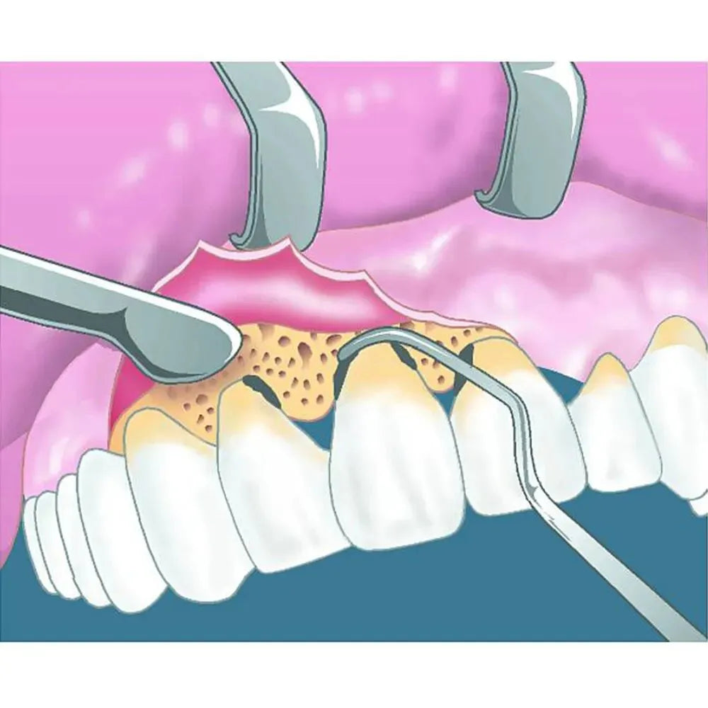 Oracraft Surgical Bone Curettes