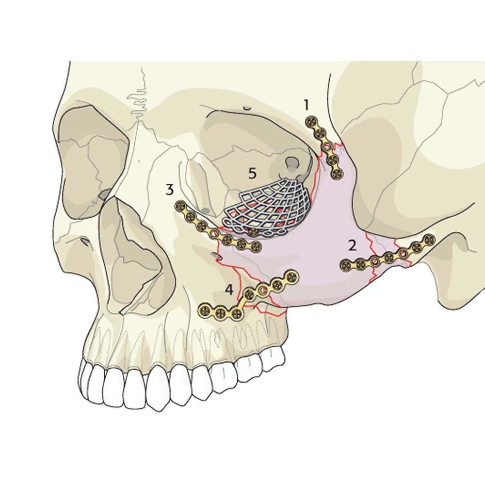 SK Surgicals SS Mini Bone Plates Orbital With Gap - 2mm