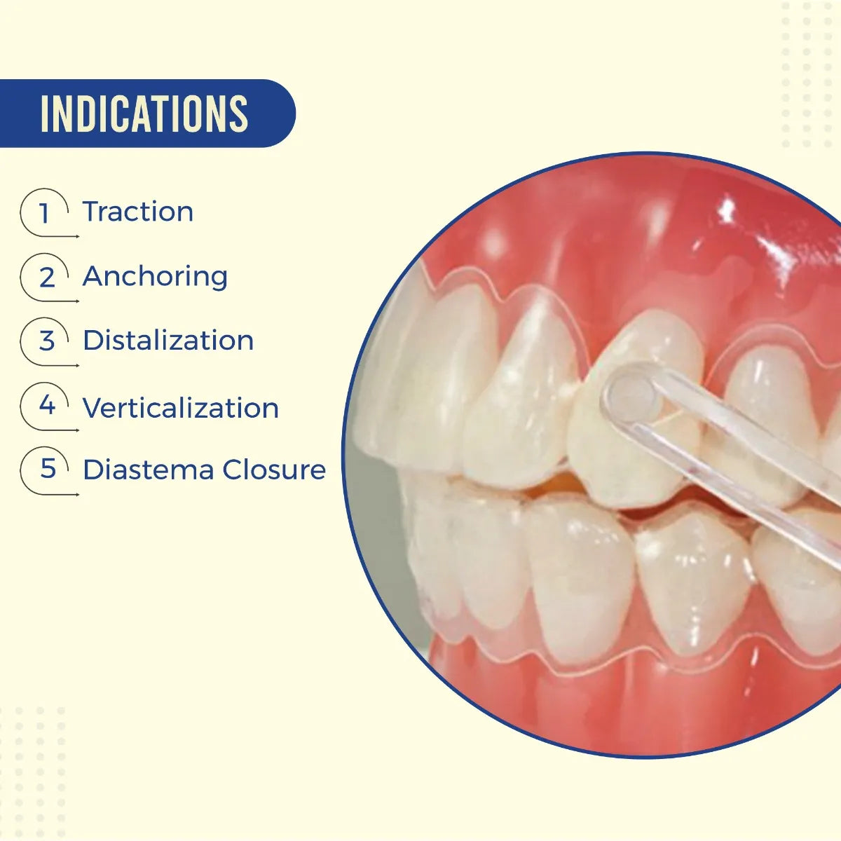 OrthoMetric Iceram Ceramic Concave Button For Bonding (2/Pk) - 30.10.3002