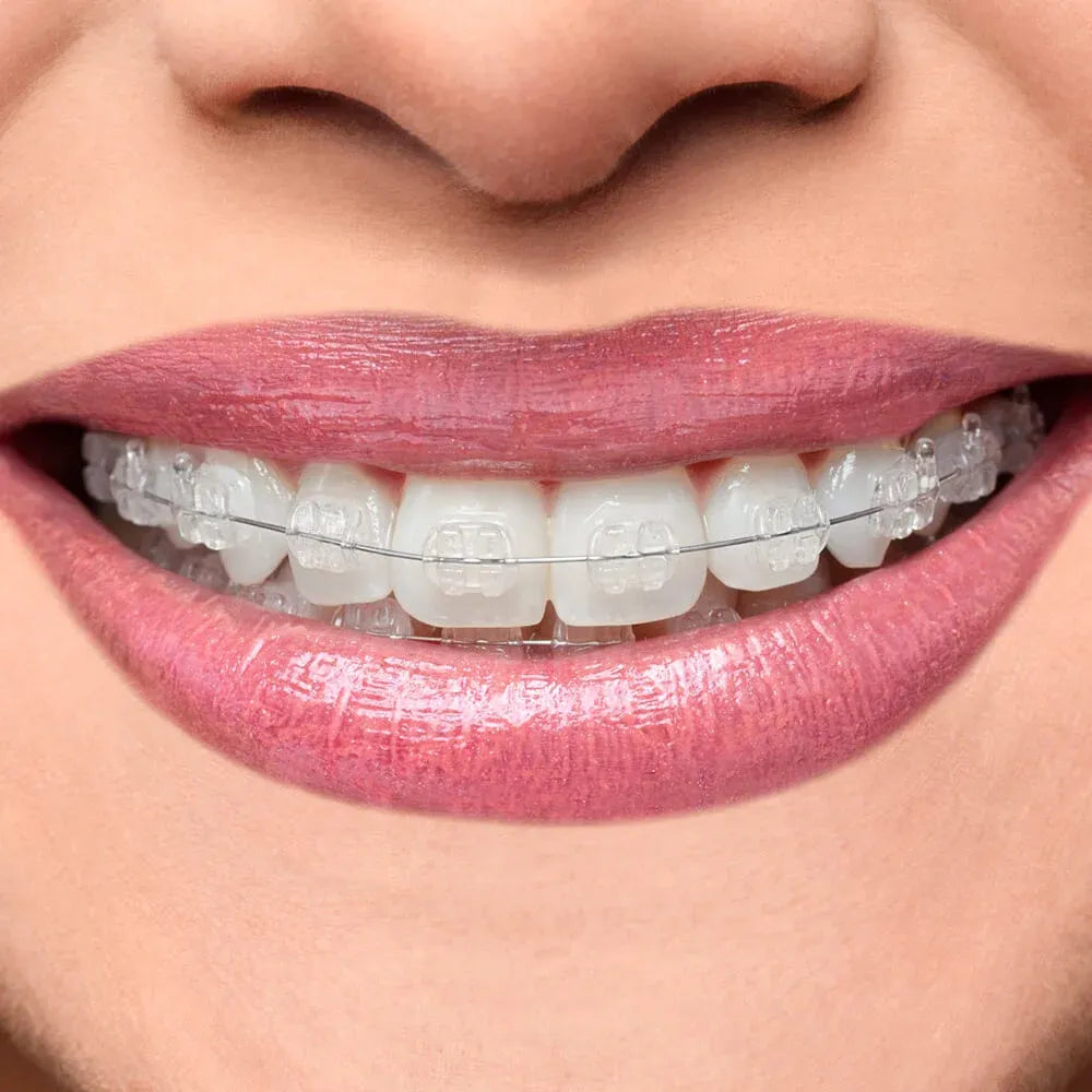 OrthoMetric Iceram Ceramic Brackets Kit - 10.81.2000