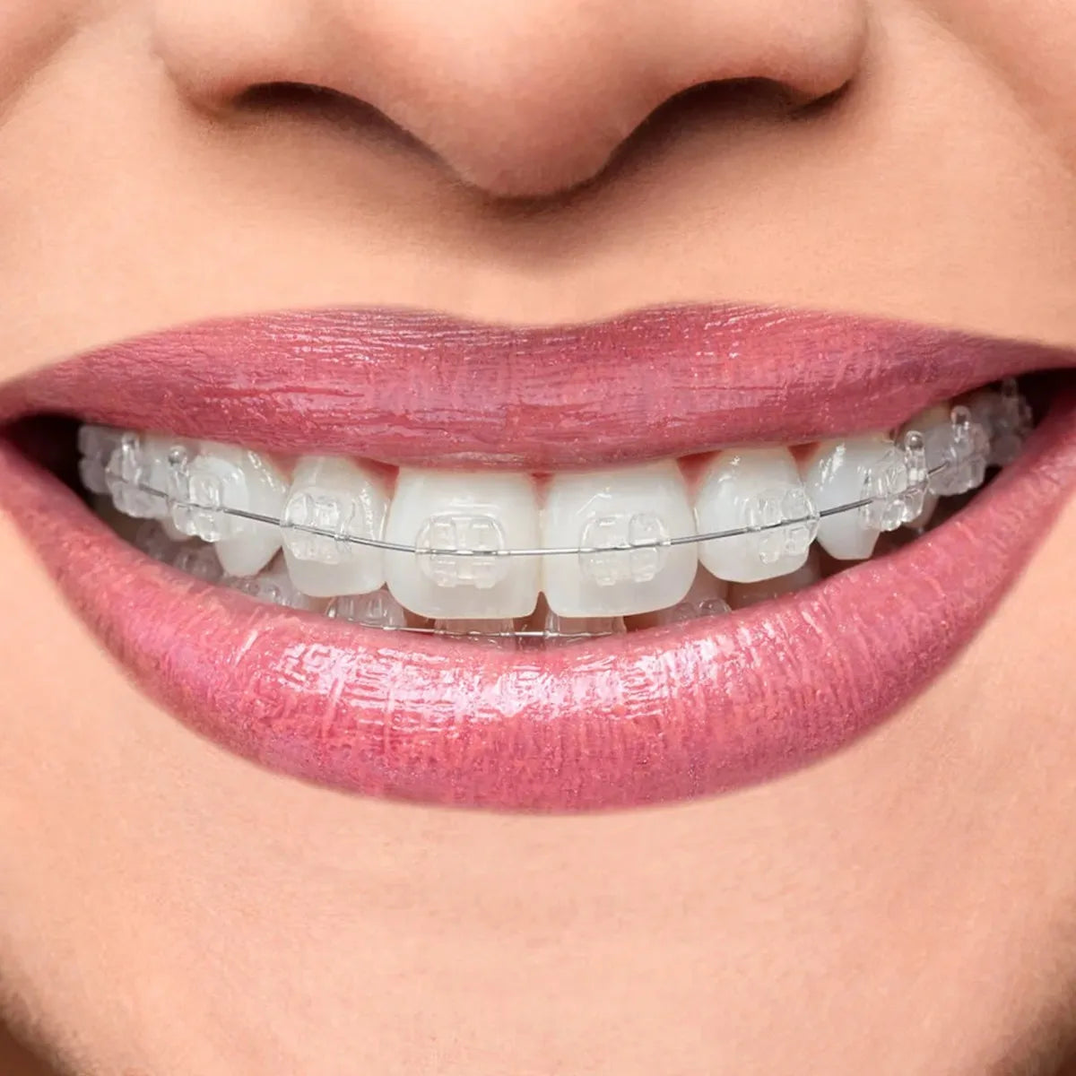 OrthoMetric Iceram - P Polycrystalline Ceramic Bracket Kit