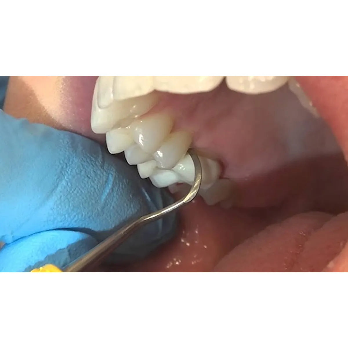 American Eagle Universal Blackjack Scalers With XP Technology