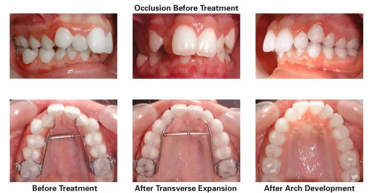 Ortho Organizers Transforce Transverse Appliance