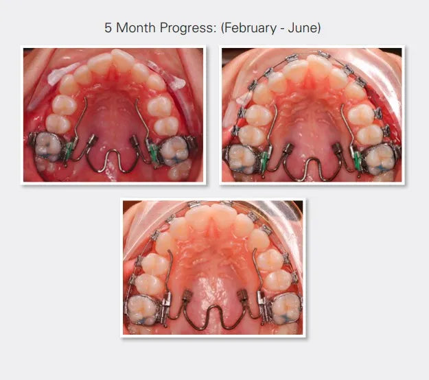 Ortho Organizers Nitanium Palatal Expander 2 Appliance