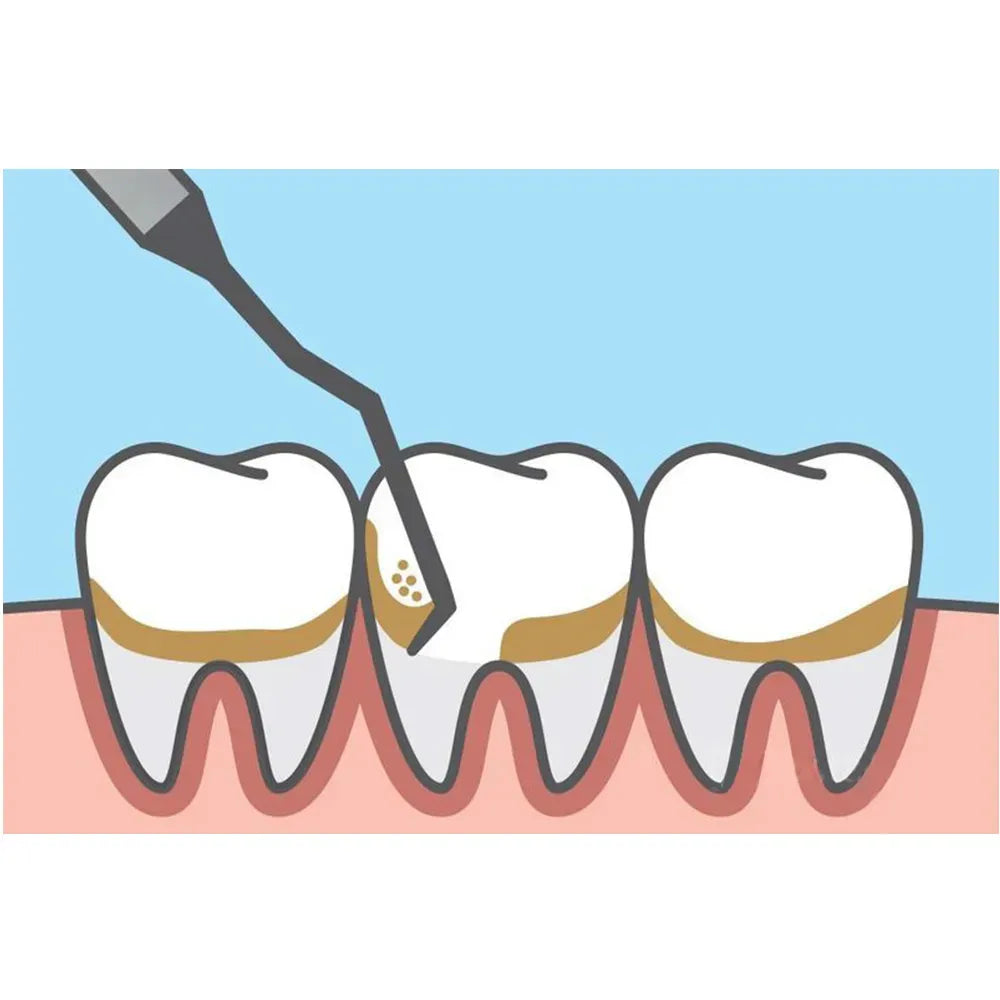 GDC Mccall Curettes #6 (Sm11/12)
