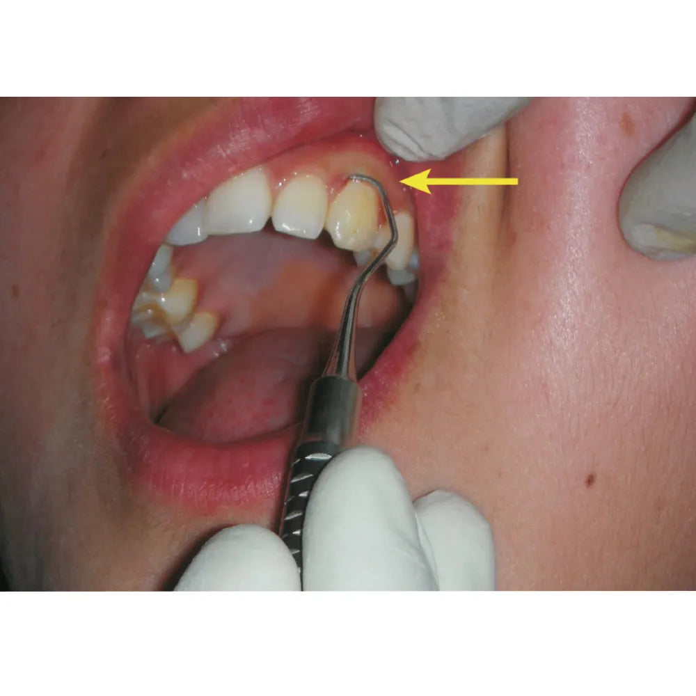 GDC Sickle Scalers Springfield #6 (Ssp2/3)
