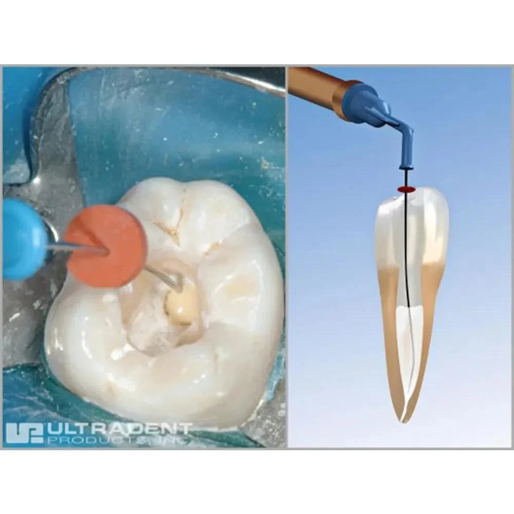 Ultradent Navi Tips Pack Of 20