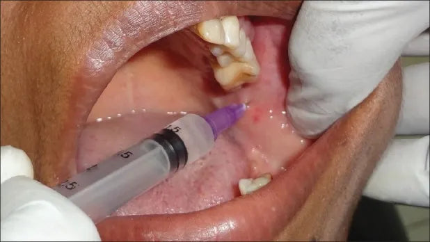 Indoco Warren Lignox Lignocaine 2% (Pack of 24)