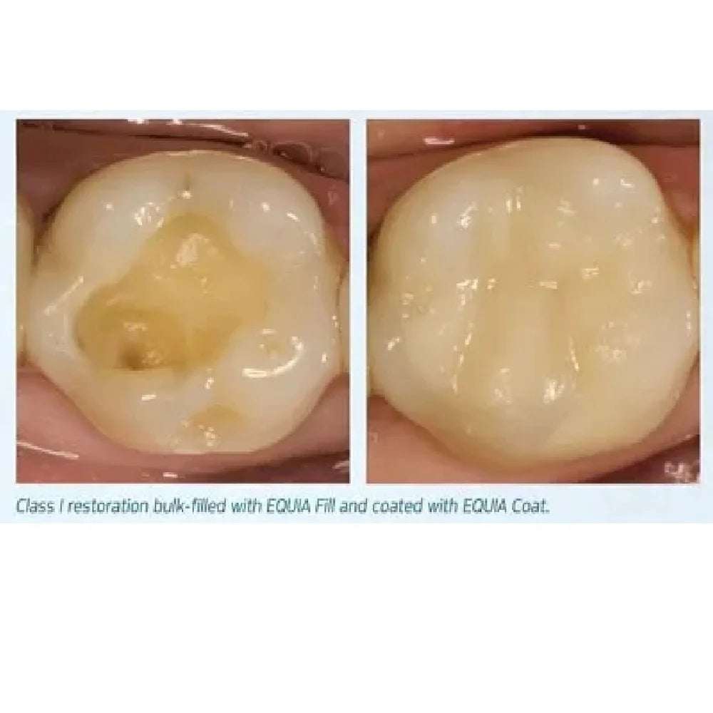 Wizdent Secure GI Fill LC