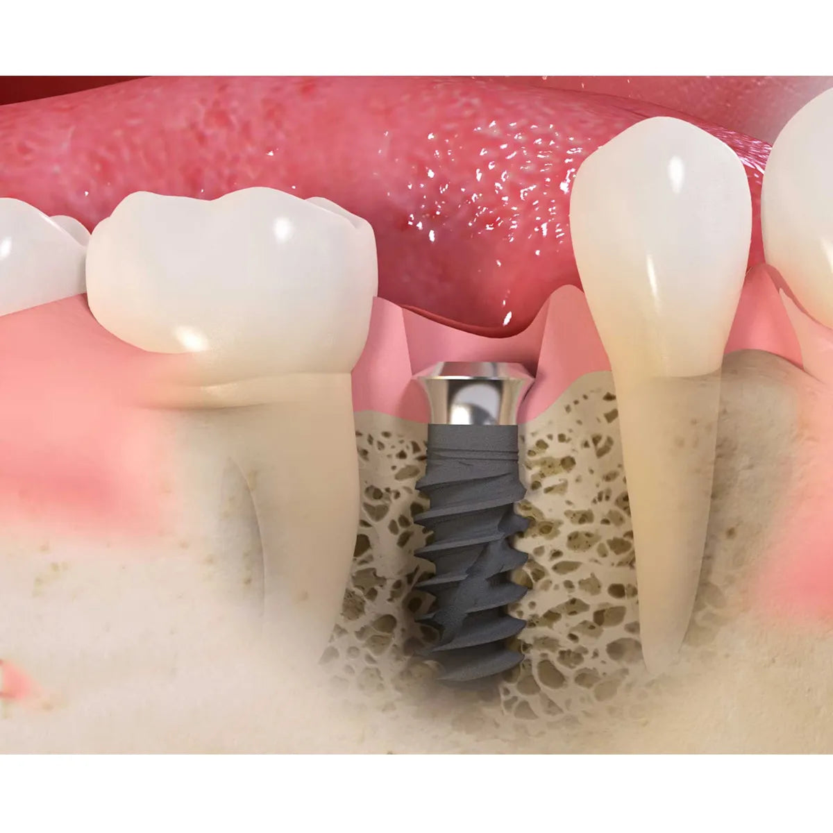 Xcem XVT Tissue Level Dental Implants