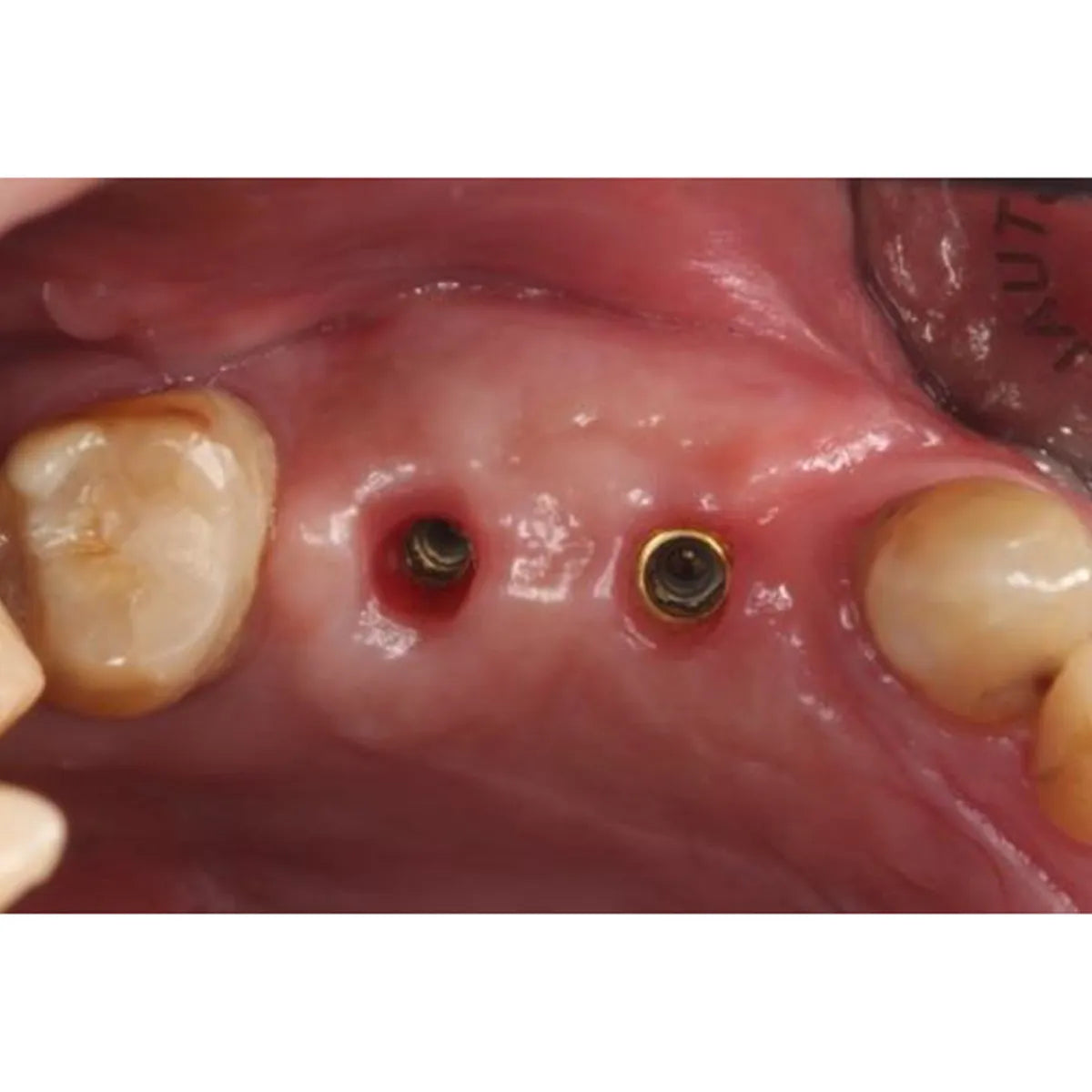 Xcem XVT Tissue Level Dental Implants